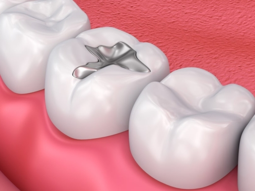 Metal Filling — Your Holistic Dentists in Casuarina, NSW