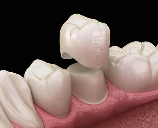3D Sample of Dental Crown — Your Holistic Dentists in Casuarina, NSW