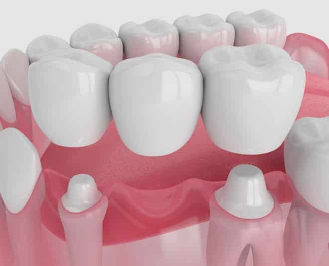 3D Model of Dental Bridge — Your Holistic Dentists in Casuarina, NSW