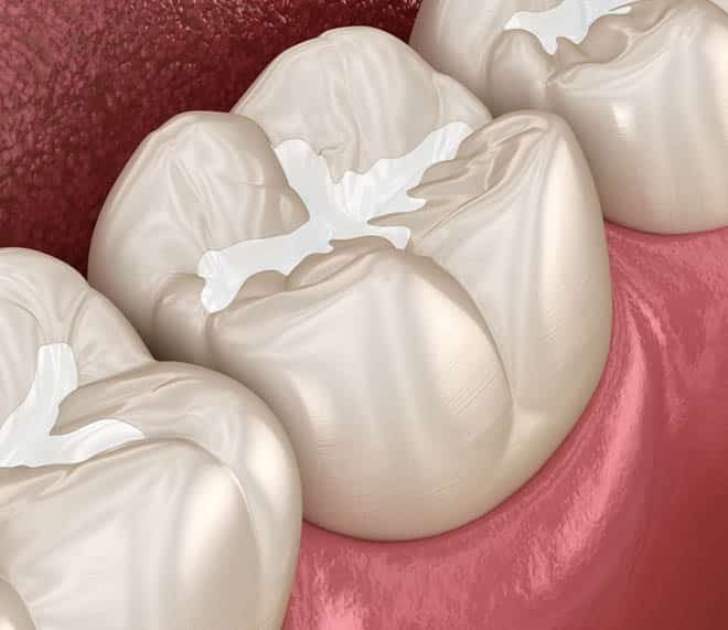 3D Model of Dental Filling — Your Holistic Dentists in Casuarina, NSW