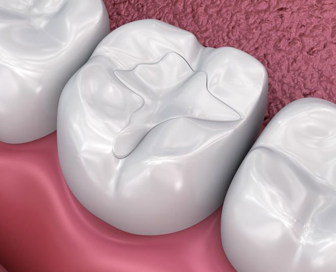 Ceramic Filling 3D Sample — Your Holistic Dentists in Casuarina, NSW