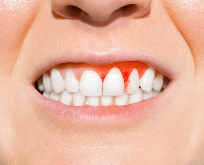 Damaged Gums — Your Holistic Dentists in Casuarina, NSW