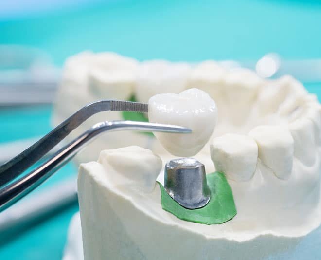 Dental Implant Model — Your Holistic Dentists in Casuarina, NSW