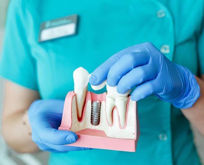 Dentist Holding Dental Implant Model — Your Holistic Dentists in Casuarina, NSW
