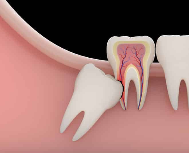 Impacted Wisdom Tooth Model — Your Holistic Dentists in Casuarina, NSW