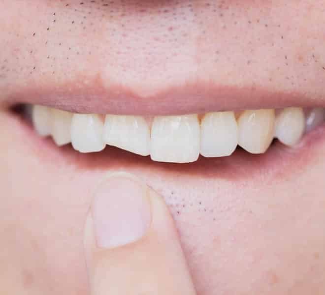 Man with Damaged Front Tooth — Your Holistic Dentists in Casuarina, NSW
