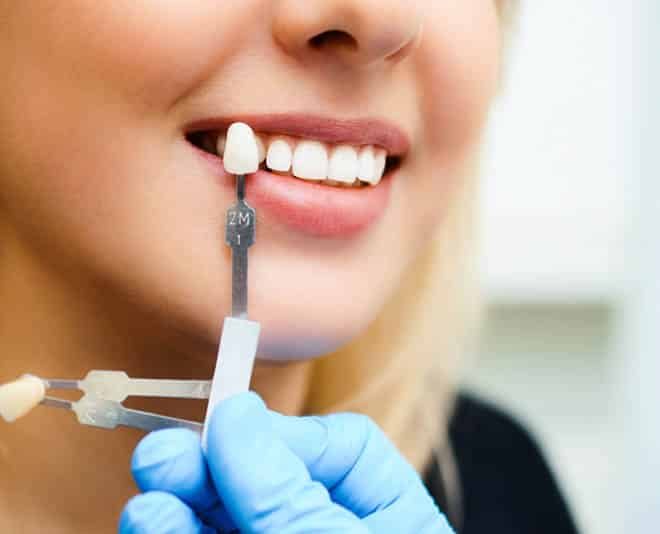 Matching the Shade of Veneer on Teeth — Your Holistic Dentists in Casuarina, NSW