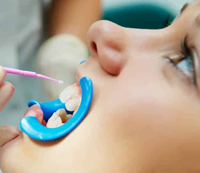Mouthguard In Patient's Mouth — Your Holistic Dentists in Casuarina, NSW