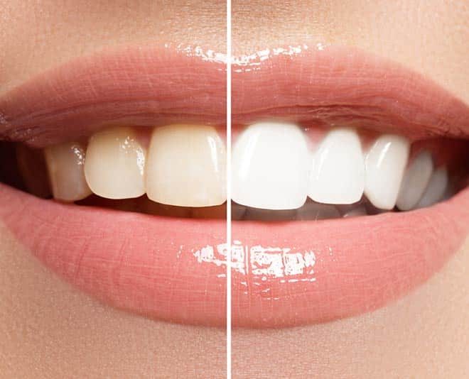 Teeth Before and After Treatment — Your Holistic Dentists in Casuarina, NSW